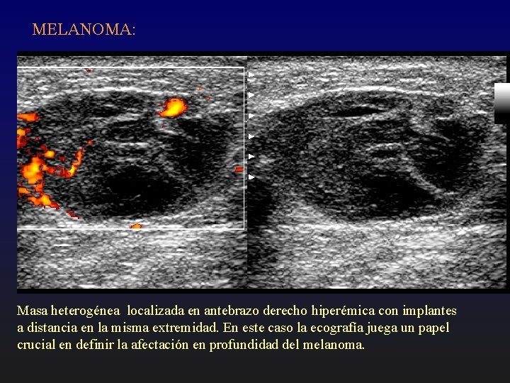 MELANOMA: Masa heterogénea localizada en antebrazo derecho hiperémica con implantes a distancia en la