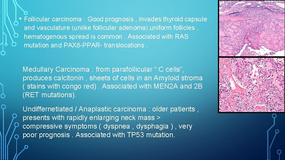 • Follicular carcinoma : Good prognosis , invades thyroid capsule and vasculature (unlike • Follicular carcinoma : Good prognosis , invades thyroid capsule and vasculature (unlike