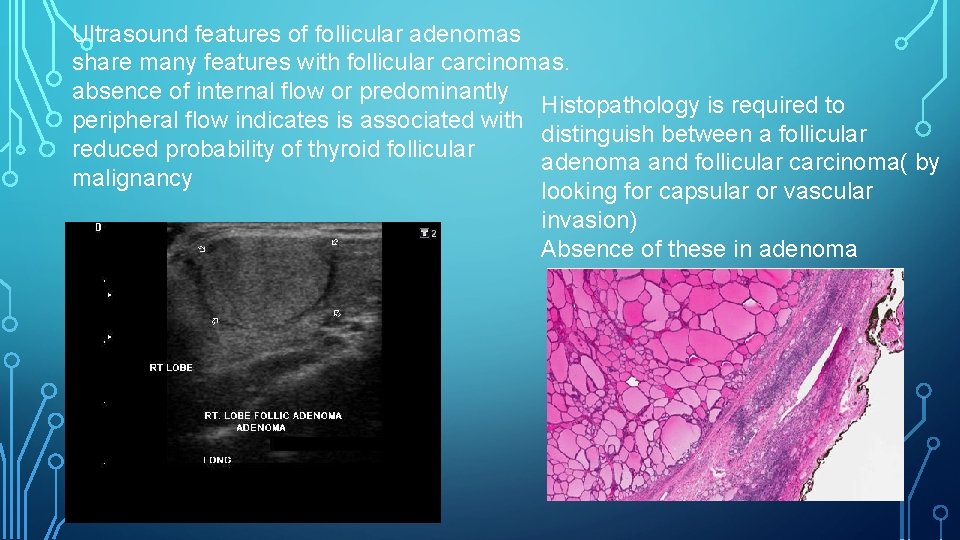Ultrasound features of follicular adenomas share many features with follicular carcinomas. absence of internal Ultrasound features of follicular adenomas share many features with follicular carcinomas. absence of internal