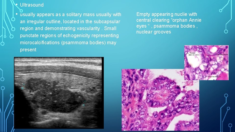 • Ultrasound • usually appears as a solitary mass usually with an irregular • Ultrasound • usually appears as a solitary mass usually with an irregular