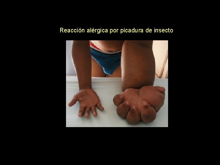 Reacción alérgica por picadura de insecto 