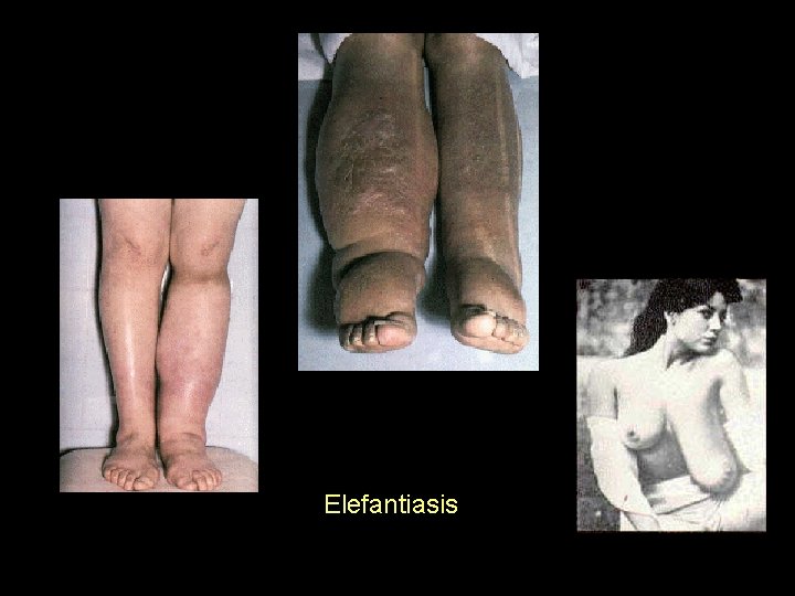 Elefantiasis 