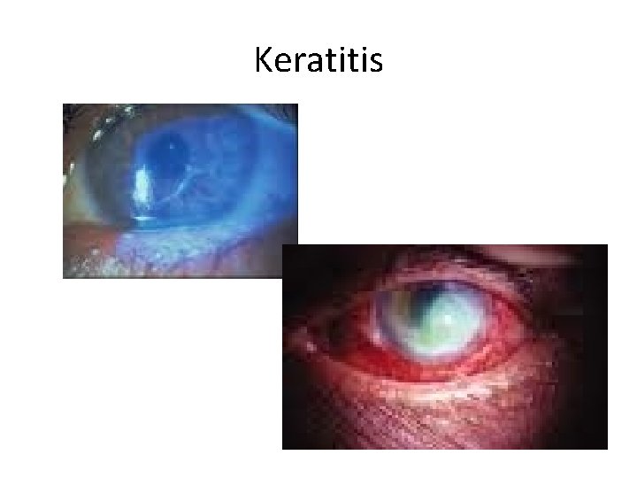 Keratitis 