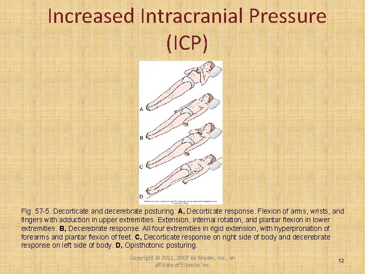 Increased Intracranial Pressure (ICP) Fig. 57 -5. Decorticate and decerebrate posturing. A, Decorticate response.