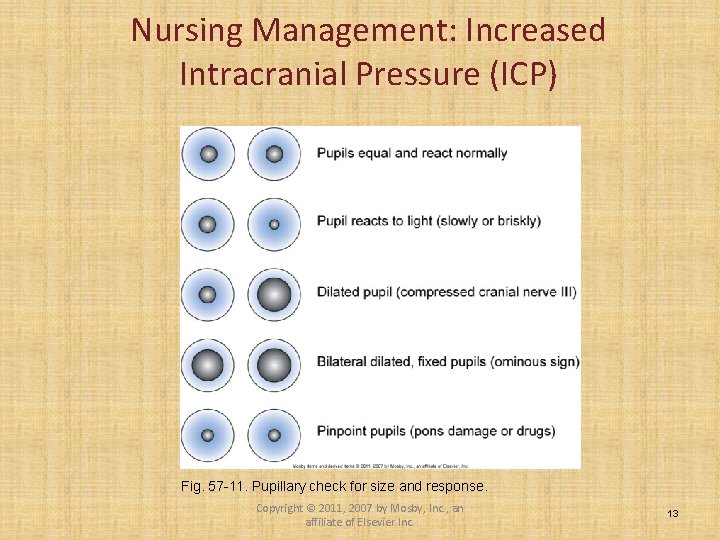 Nursing Management: Increased Intracranial Pressure (ICP) Fig. 57 -11. Pupillary check for size and