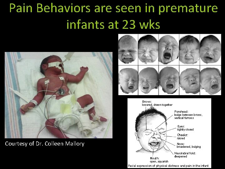 Pain Behaviors are seen in premature infants at 23 wks Courtesy of Dr. Colleen