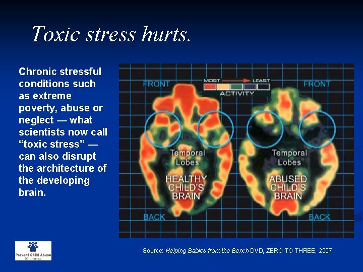 Toxic stress hurts. Chronic stressful conditions such as extreme poverty, abuse or neglect —