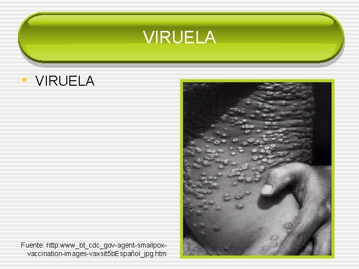 VIRUELA • VIRUELA Fuente: http: www_bt_cdc_gov-agent-smallpoxvaccination-images-vaxsit 5 b. Español_jpg. htm 