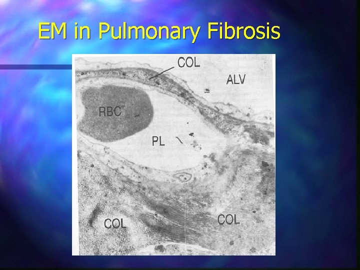 EM in Pulmonary Fibrosis 