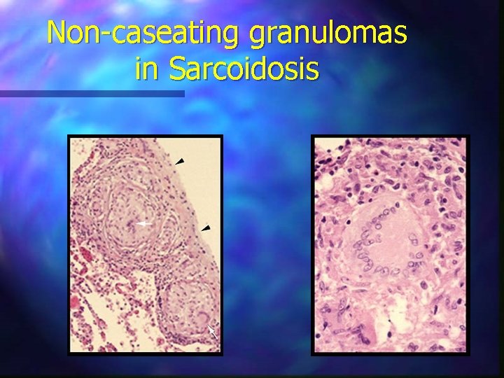 Non-caseating granulomas in Sarcoidosis 