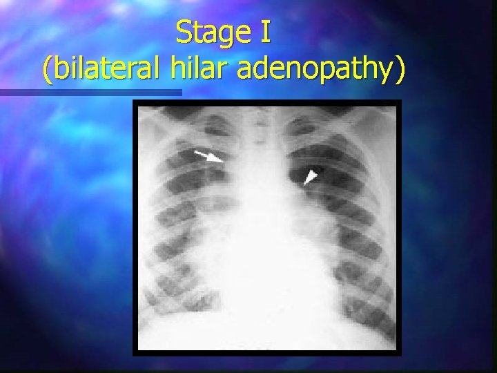 Stage I (bilateral hilar adenopathy) 