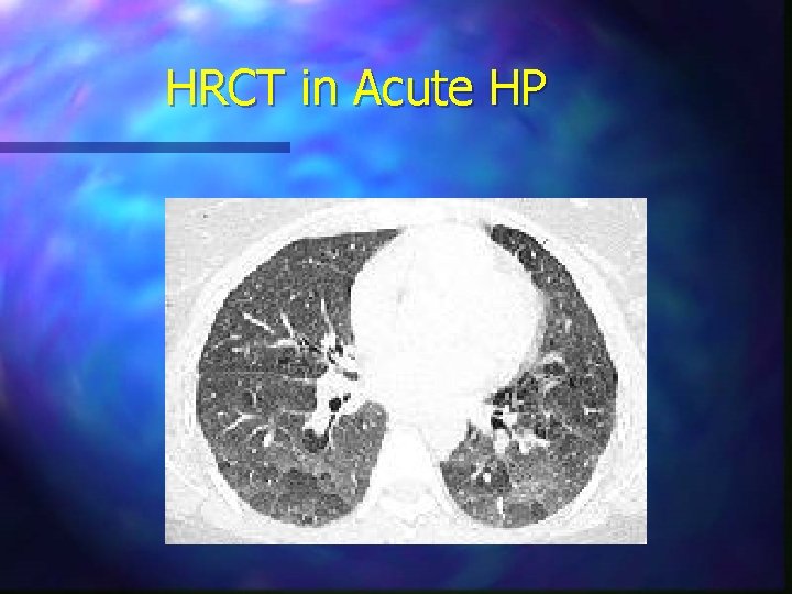 HRCT in Acute HP 