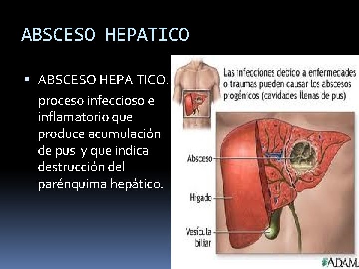 ABSCESO HEPATICO ABSCESO HEPA TICO. proceso infeccioso e inflamatorio que produce acumulación de pus