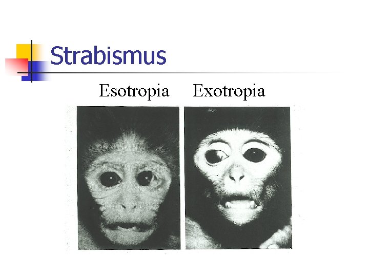 Strabismus Esotropia Exotropia 