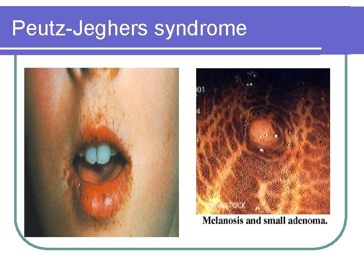Peutz-Jeghers syndrome Peutz-Jeghers syndrome