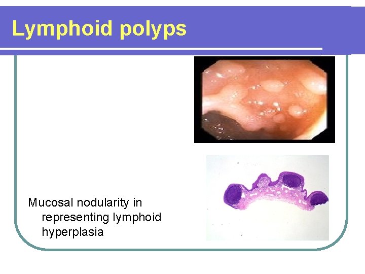 Lymphoid polyps Mucosal nodularity in representing lymphoid hyperplasia Lymphoid polyps Mucosal nodularity in representing lymphoid hyperplasia