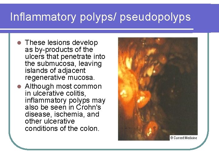 Inflammatory polyps/ pseudopolyps These lesions develop as by-products of the ulcers that penetrate into Inflammatory polyps/ pseudopolyps These lesions develop as by-products of the ulcers that penetrate into