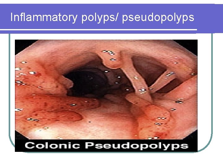 Inflammatory polyps/ pseudopolyps Inflammatory polyps/ pseudopolyps
