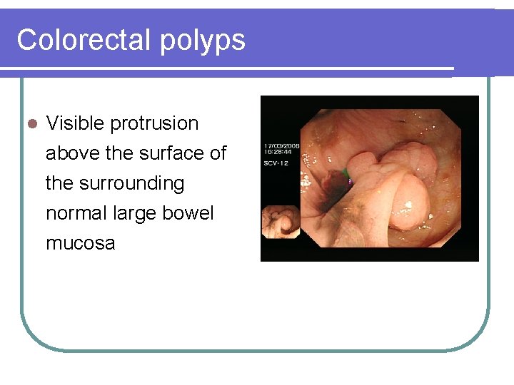 Colorectal polyps l Visible protrusion above the surface of the surrounding normal large bowel Colorectal polyps l Visible protrusion above the surface of the surrounding normal large bowel