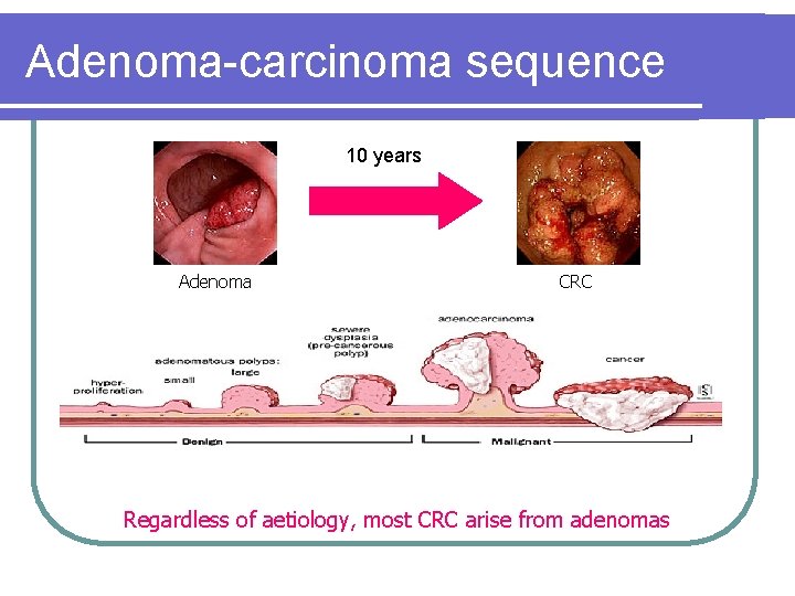 Adenoma-carcinoma sequence 10 years Adenoma CRC Regardless of aetiology, most CRC arise from adenomas Adenoma-carcinoma sequence 10 years Adenoma CRC Regardless of aetiology, most CRC arise from adenomas