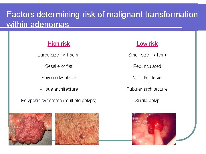 Factors determining risk of malignant transformation within adenomas High risk Low risk Large size Factors determining risk of malignant transformation within adenomas High risk Low risk Large size