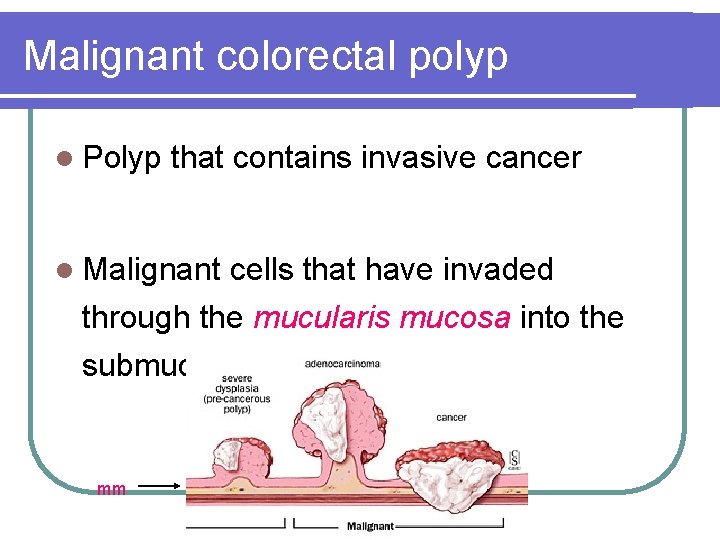 Malignant colorectal polyp l Polyp that contains invasive cancer l Malignant cells that have Malignant colorectal polyp l Polyp that contains invasive cancer l Malignant cells that have