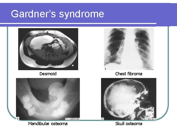Gardner’s syndrome Desmoid Chest fibroma Mandibular osteoma Skull osteoma Gardner’s syndrome Desmoid Chest fibroma Mandibular osteoma Skull osteoma
