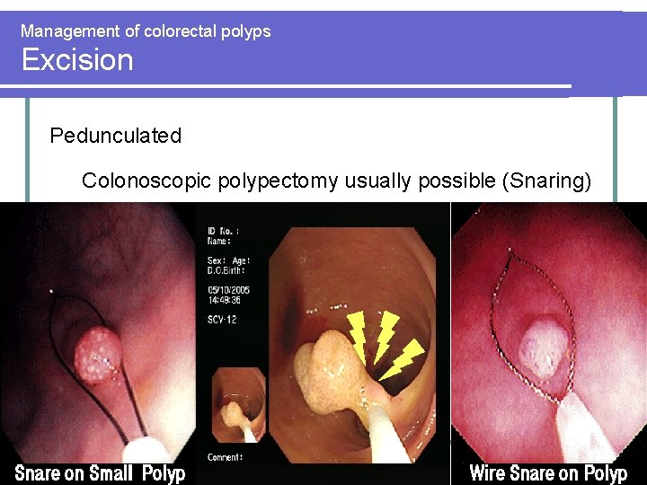 Management of colorectal polyps Excision Pedunculated Colonoscopic polypectomy usually possible (Snaring) Management of colorectal polyps Excision Pedunculated Colonoscopic polypectomy usually possible (Snaring)