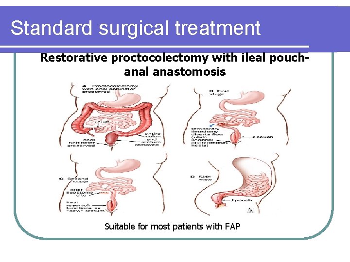 Standard surgical treatment Restorative proctocolectomy with ileal pouchanal anastomosis Suitable for most patients with Standard surgical treatment Restorative proctocolectomy with ileal pouchanal anastomosis Suitable for most patients with