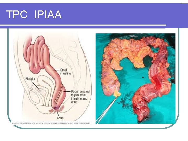 TPC IPIAA TPC IPIAA