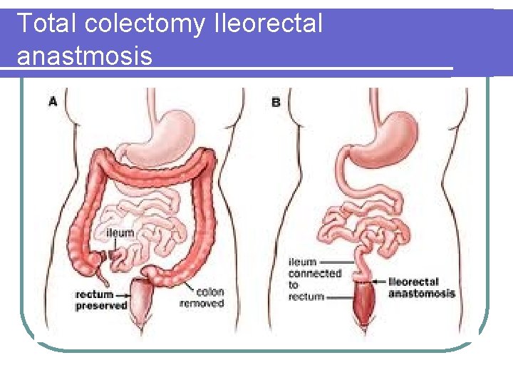 Total colectomy Ileorectal anastmosis Total colectomy Ileorectal anastmosis