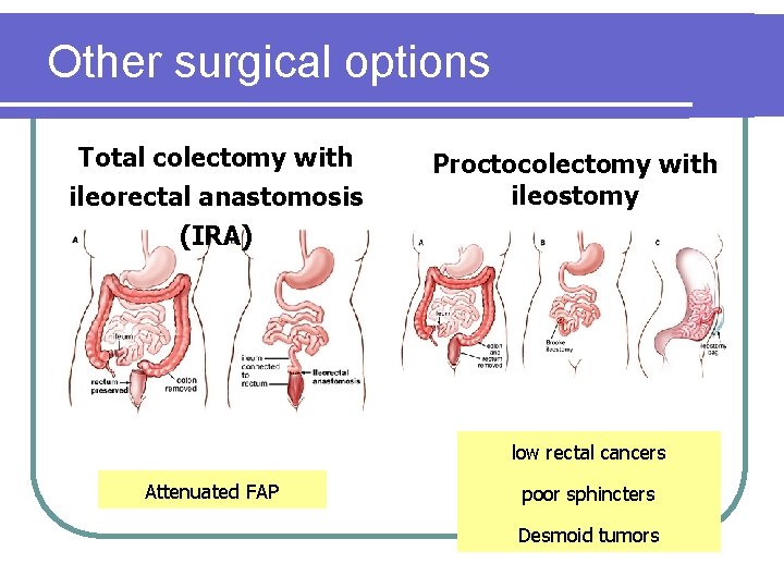 Other surgical options Total colectomy with ileorectal anastomosis (IRA) Proctocolectomy with ileostomy low rectal Other surgical options Total colectomy with ileorectal anastomosis (IRA) Proctocolectomy with ileostomy low rectal