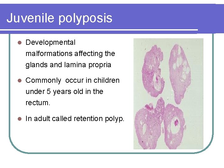 Juvenile polyposis l Developmental malformations affecting the glands and lamina propria l Commonly occur Juvenile polyposis l Developmental malformations affecting the glands and lamina propria l Commonly occur