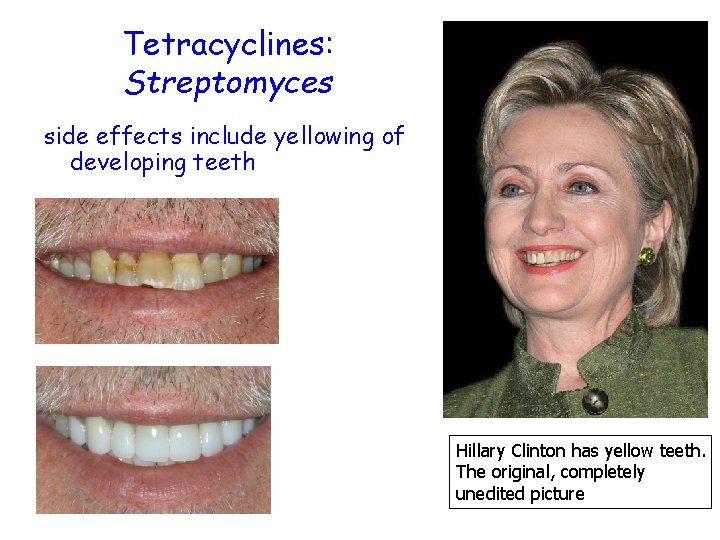 Tetracyclines: Streptomyces side effects include yellowing of developing teeth Hillary Clinton has yellow teeth.