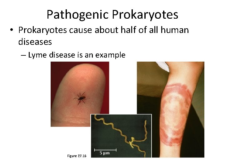 Pathogenic Prokaryotes • Prokaryotes cause about half of all human diseases – Lyme disease