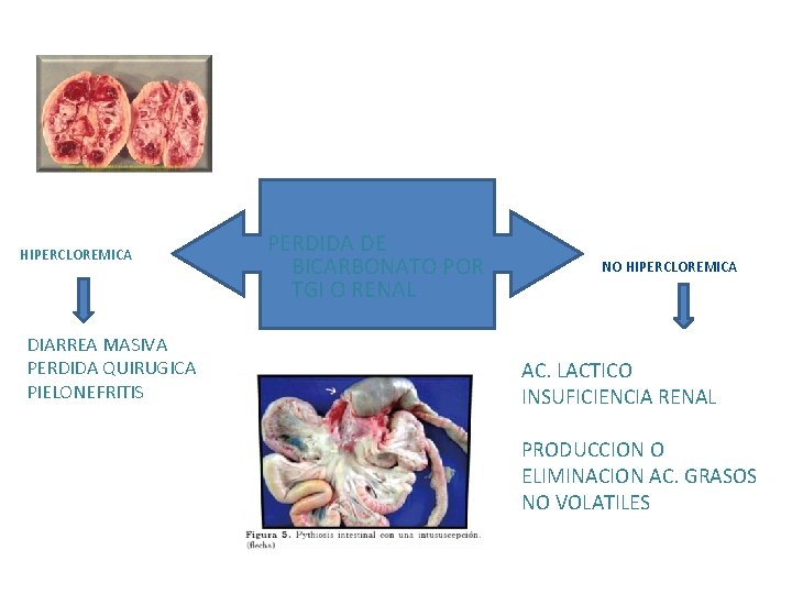 HIPERCLOREMICA DIARREA MASIVA PERDIDA QUIRUGICA PIELONEFRITIS PERDIDA DE BICARBONATO POR TGI O RENAL NO