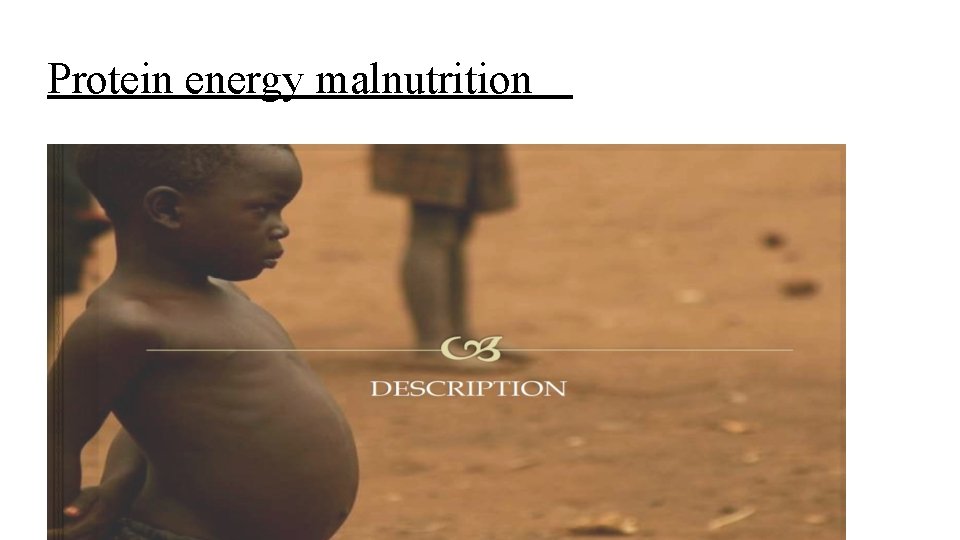 Protein energy malnutrition 