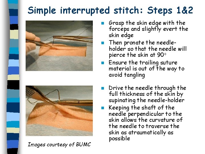 Simple interrupted stitch: Steps 1&2 Grasp the skin edge with the forceps and slightly