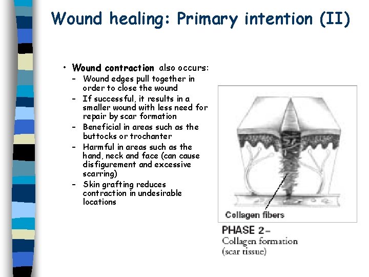 Wound healing: Primary intention (II) • Wound contraction also occurs: – Wound edges pull