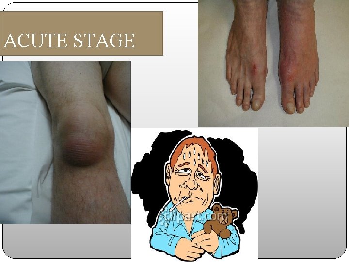 ACUTE STAGE 