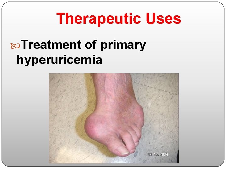 Therapeutic Uses Treatment of primary hyperuricemia 