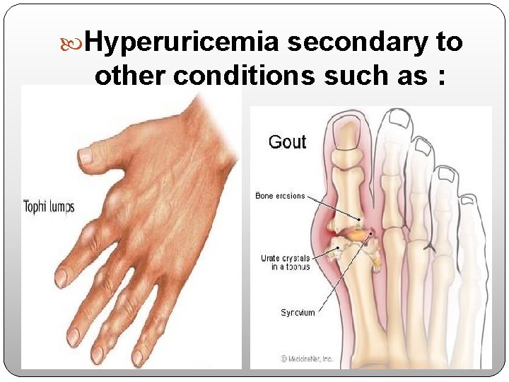  Hyperuricemia secondary to other conditions such as : 