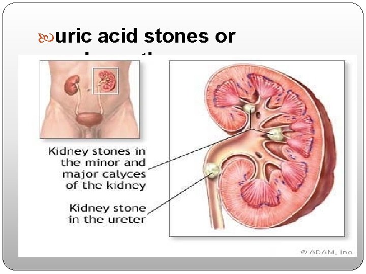  uric acid stones or nephropathy. 