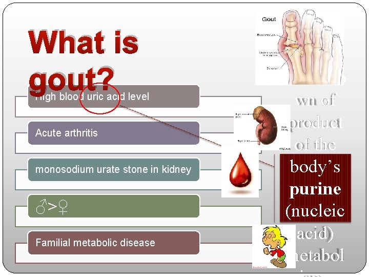 What is gout? High blood uric acid level Acute arthritis monosodium urate stone in