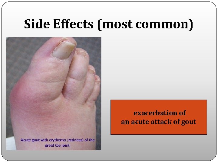 Side Effects (most common) exacerbation of an acute attack of gout 