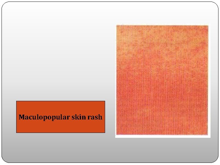 Maculopopular skin rash 