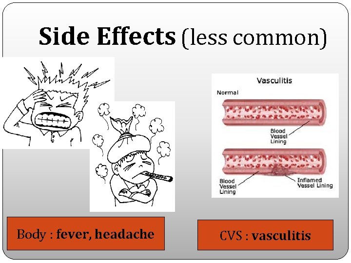 Side Effects (less common) Body : fever, headache CVS : vasculitis 