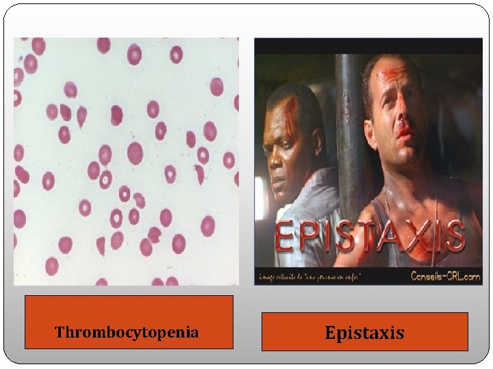 Thrombocytopenia Epistaxis 