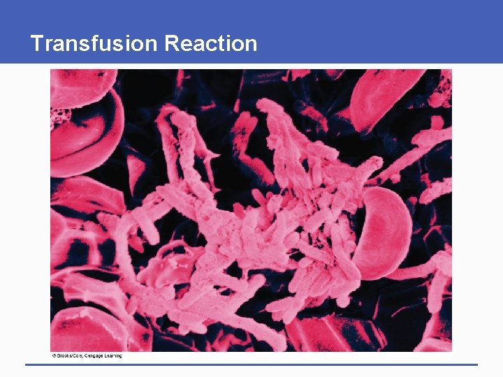 Transfusion Reaction 