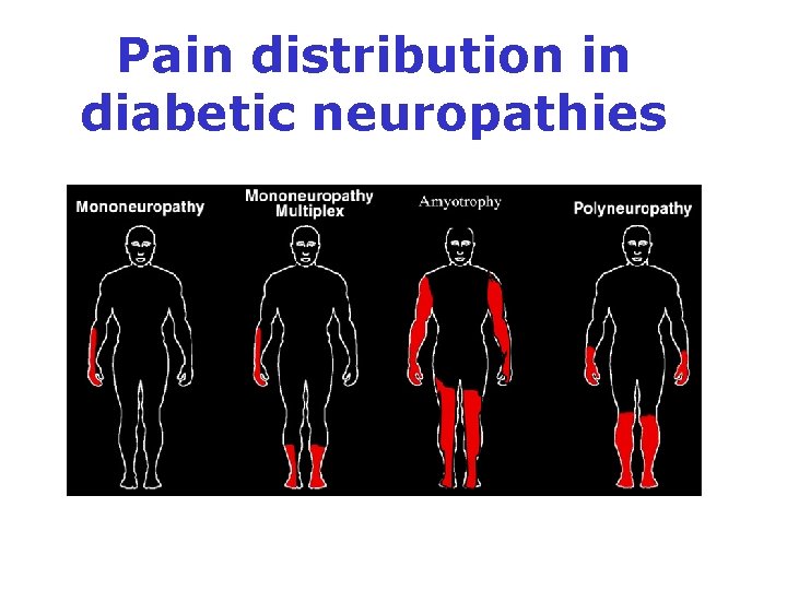Pain distribution in diabetic neuropathies 